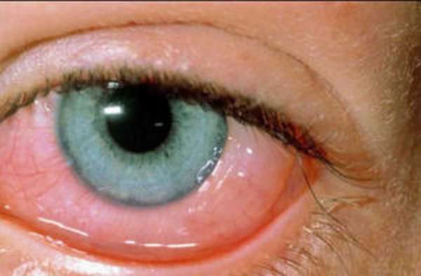 фото глаза с конъюнктивитом аллергическим